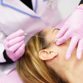 PDO Thread Mini Face Lift - S2G Medical Spa