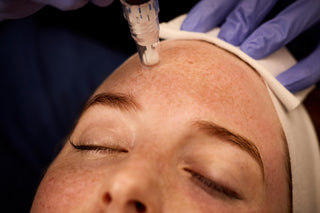 SkinPen® Microneedling
