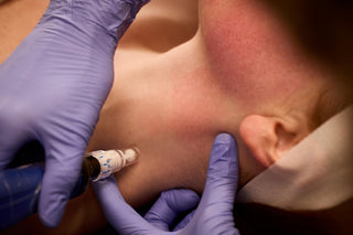 SkinPen® Microneedling